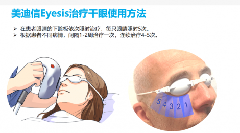 舒緩眼部不適， 干眼理療儀成為您的良好選擇