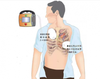 心電圖機的正確使用步驟是什么？朗逸器械百科